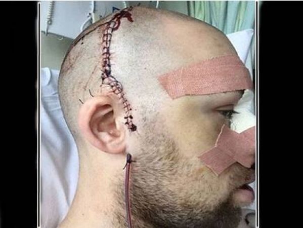 प्रैक्टिक्स के दौरान इंग्लैंड खिलाडी की सर सहित चेहरे की 15 हड्डिया टूटी
