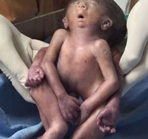 राजकोट में पैदा हुए इस बच्चे के है दो दिल और चार हाथ-पैर
