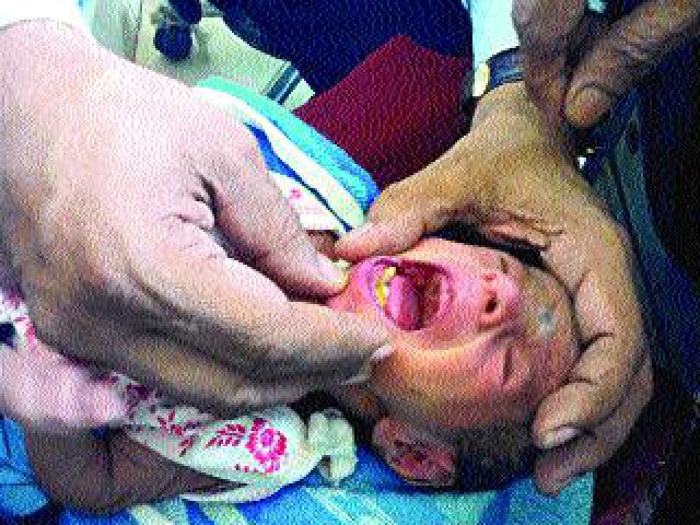 नेटल टीथ से जन्मे बच्चे ने डॉक्टरों को अचम्भे में डाला-भिलाई