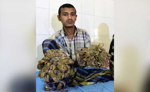 Tree man से बनाया आम आदमी, सर्जरी कर निकाले पेड़ की छाल जैसे मस्से