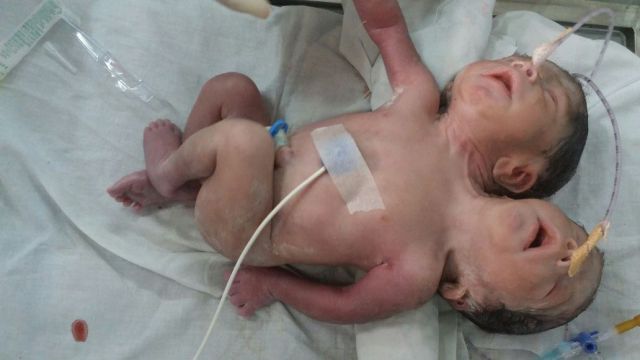 अजमेर में जन्मा दो सिर वाला बच्चा