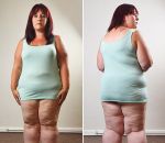 अजीब बीमारी के चलते इनकी Thighs का वजन हो गया 51 किलो