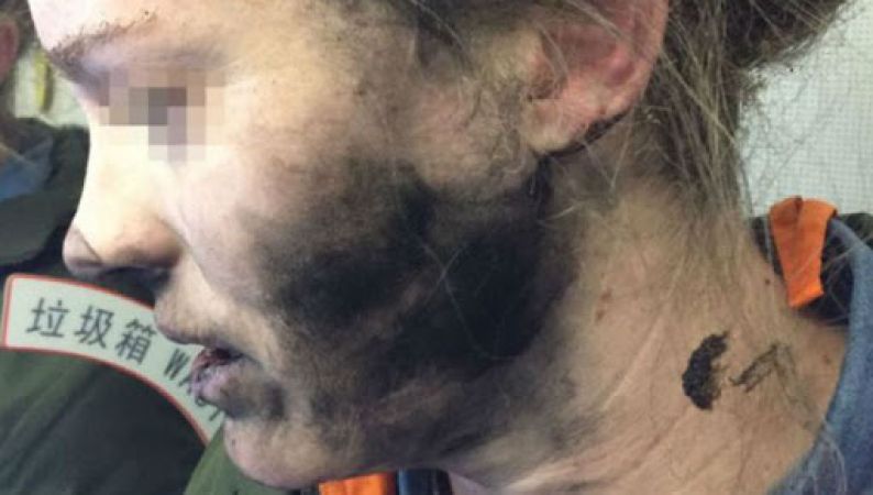 Lithium ion battery headphone explosion caused serious facial injuries to woman