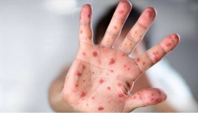 Third case of monkeypox in Delhi, Nigerian youth found infected