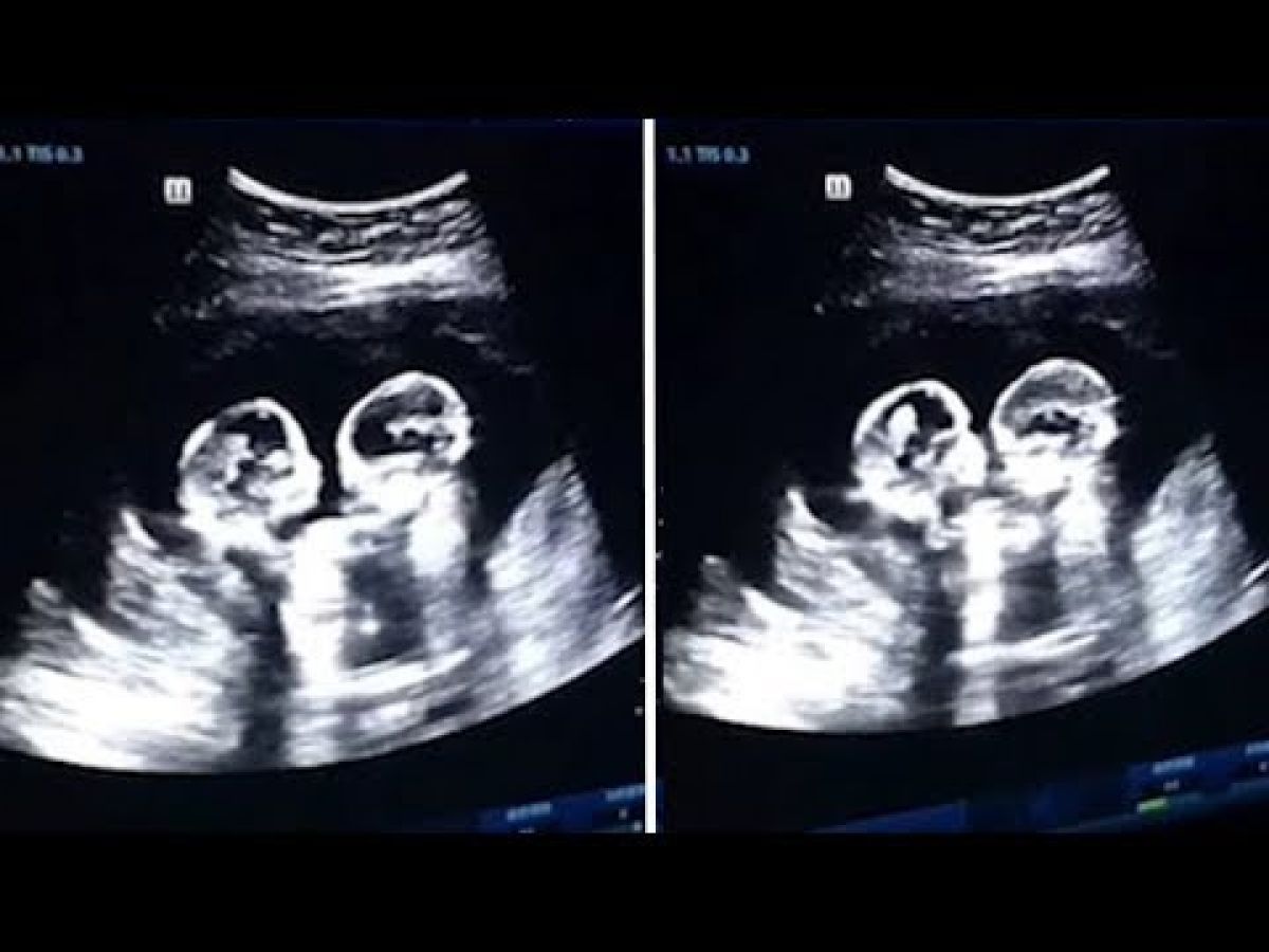 Video : माँ के गर्भ में लड़े जुड़वाँ बच्चे, देखकर सभी हैं हैरान