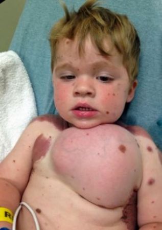 खतरनाक बीमारी के चलते 5 साल के बच्चे के शरीर में किया गया ब्रैस्ट इम्प्लांट