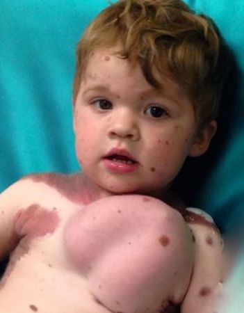 खतरनाक बीमारी के चलते 5 साल के बच्चे के शरीर में किया गया ब्रैस्ट इम्प्लांट