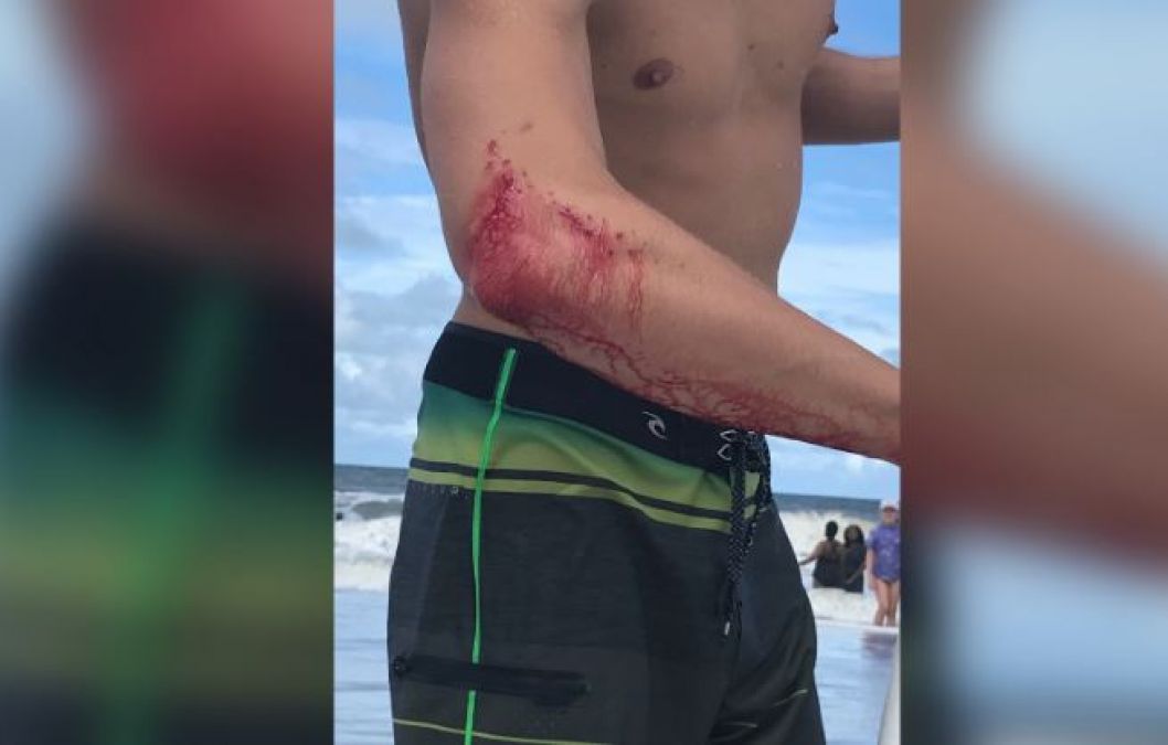 18-year-old surfer bitten on the hand by a shark at Florida beach