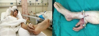 डाॅक्टर ने कर दिया अजीबों-गरीब आॅपरेशन, कटे हाथ को जोड़ दिया पैर से