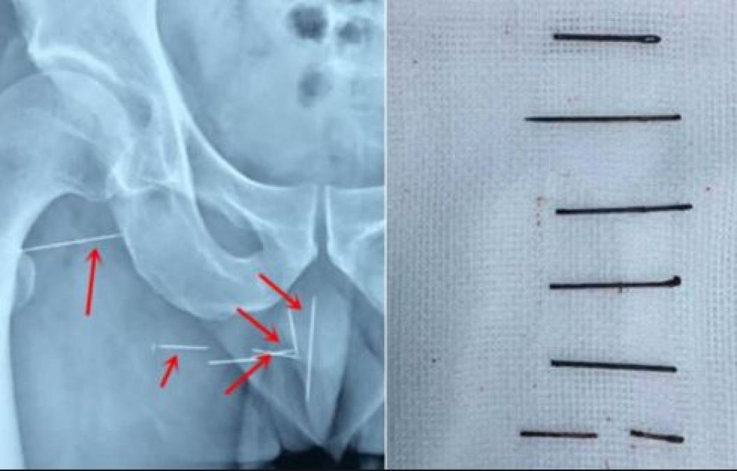 Young Man suffered from lower back pain for 10 years, Operated On Dangerous Things