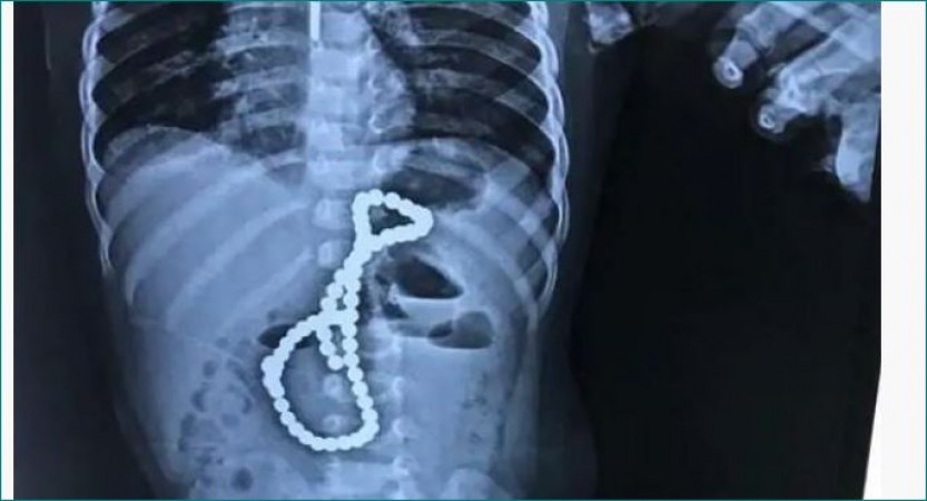 Doctor save life of 1 and half-year-old innocent who swallowed 65 beads of magnet