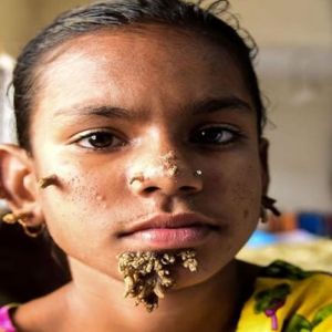 बांग्लादेशी लड़की को हुई अजीब बीमारी, लोग कहने लगे Tree Woman