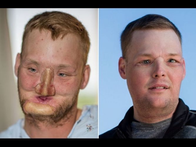 जानलेवा हादसों ने छिना इनका चेहरा, सर्जरी के बाद मिला नया चेहरा