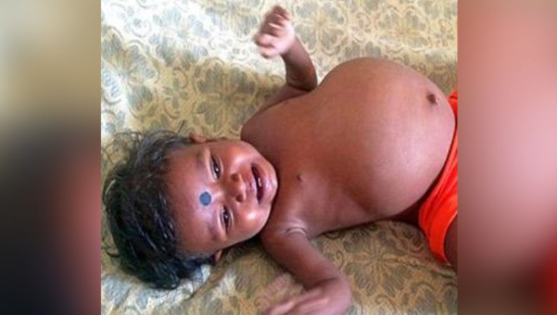 15 महीने की बच्ची के पेट में पल रहे थे जुड़वां बच्चे, कहानी जानकर उड़ जाएंगे होश
