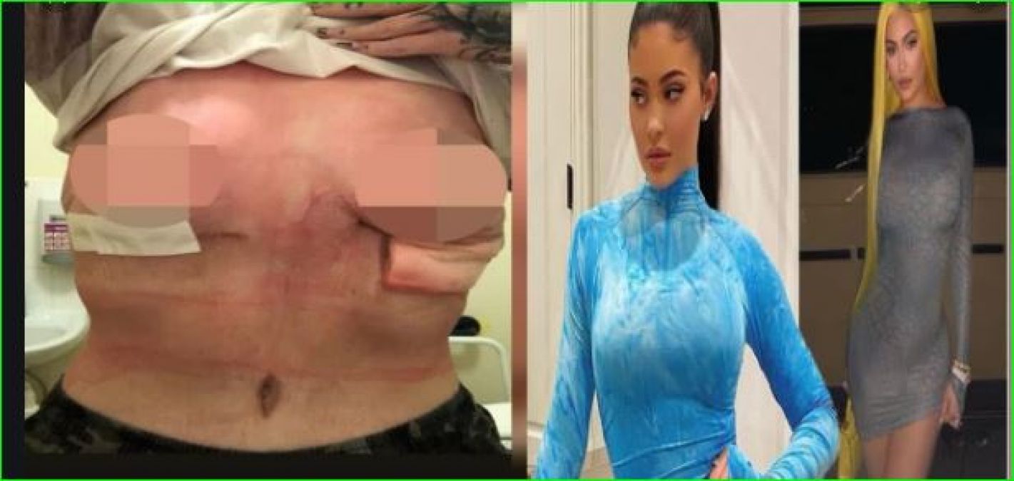 Woman's breast implant surgery failed, wanted to increase the size