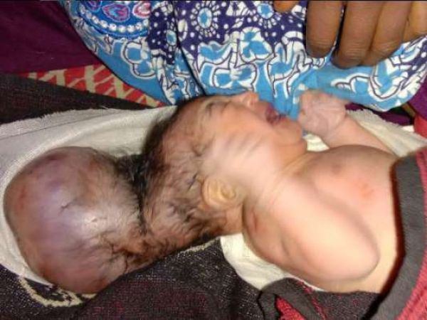 महिला ने जन्म दिया दो सिर वाले विचित्र बच्चे को, देखकर सभी हैं हैरान