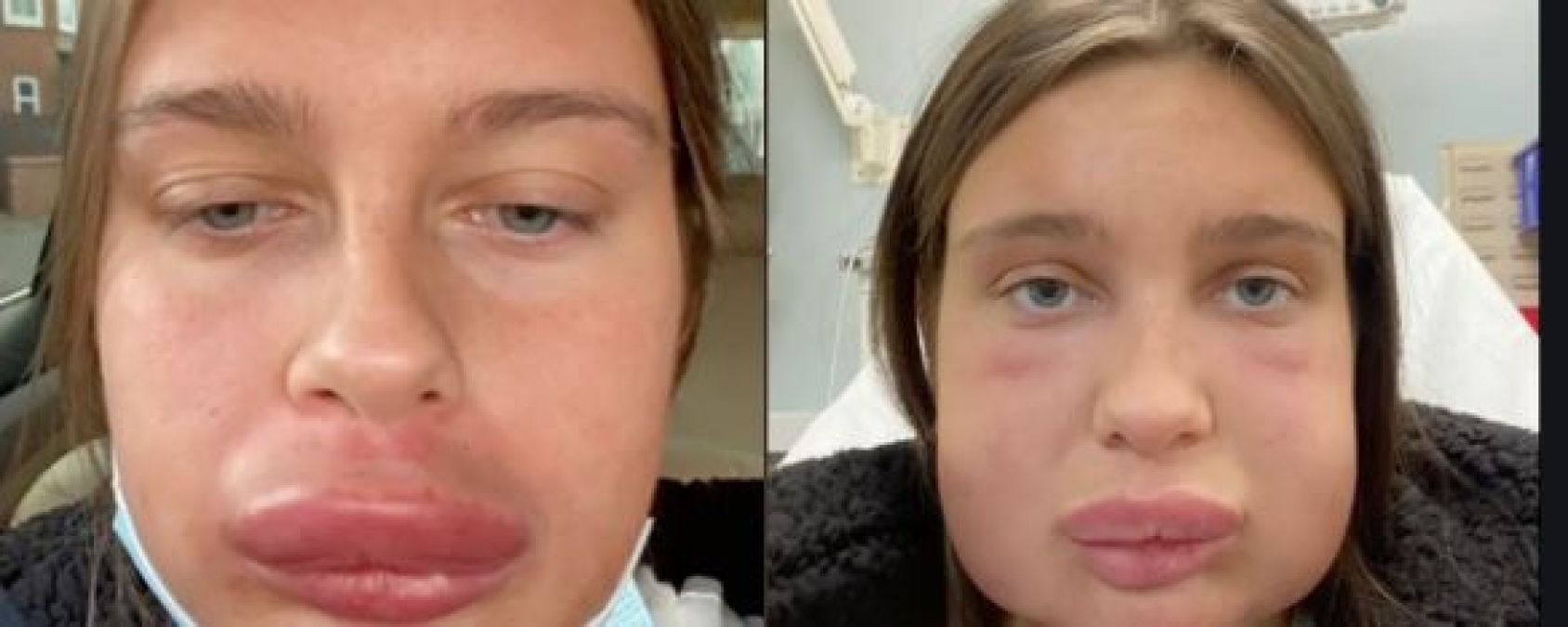 Surgery impaired woman's lips like balloons