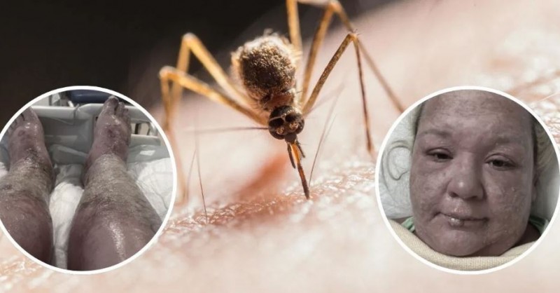 OMG! This woman's skin melted like plastic from a mosquito bite