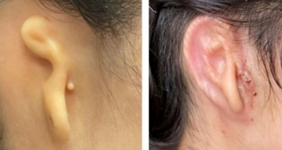 Shocking, 3D printed ear made from a girl's cells successfully