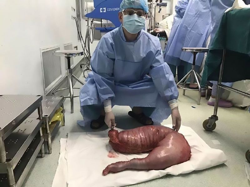 22 साल के इस शख्स के पेट से निकला 13 किलो का ट्यूमर, जिससे डॉक्टर्स भी हो गए हैरान