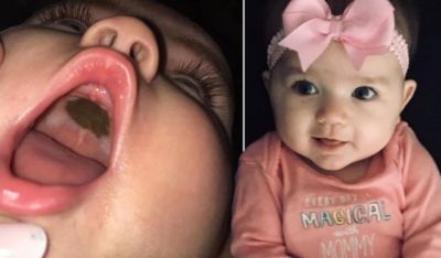 Mother get nervous by looking black scar in baby girl's mouth, by knowing fact missed out a laugh