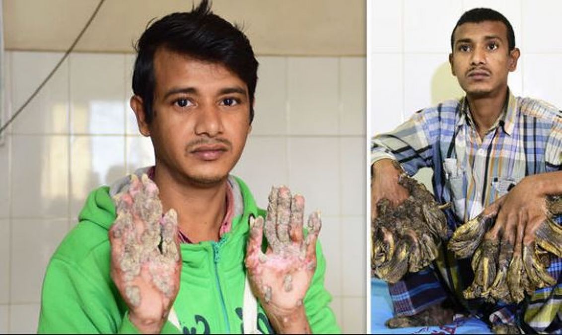 Bangladesh’s ‘tree man’ wants hands amputated: Everything to know about the rare disease