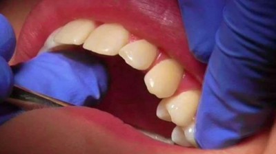 OMG! The 10-year-old child had 50 teeth in his mouth, even the doctors were stunned to see 30 teeth removed