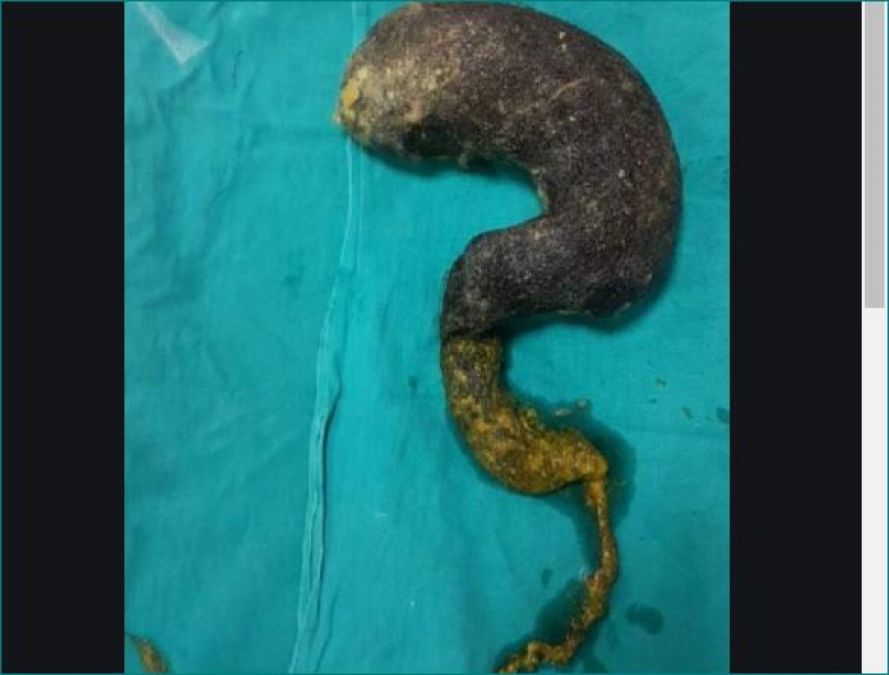 Girl gets stomachache, doctor found something during operation that blown senses