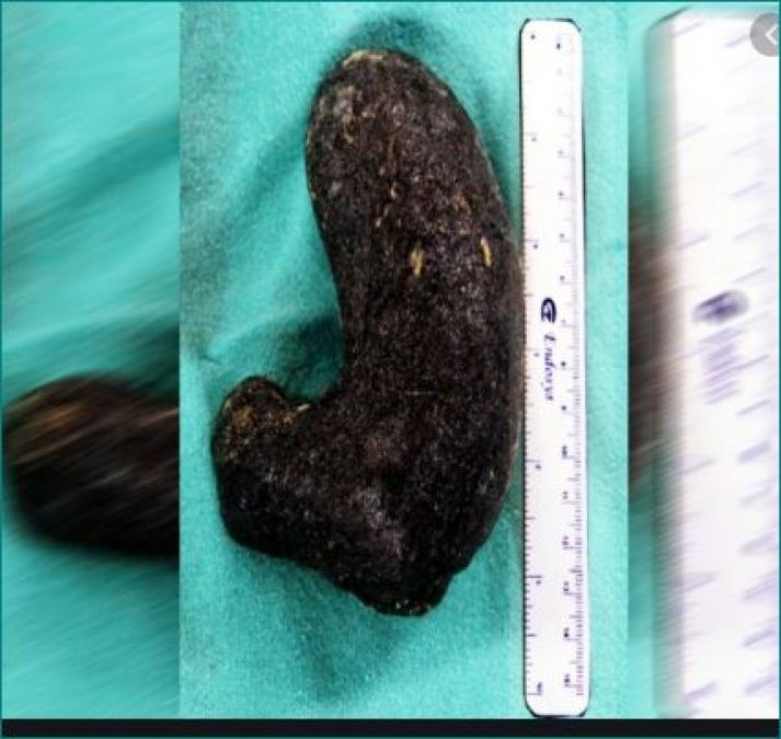 Girl gets stomachache, doctor found something during operation that blown senses