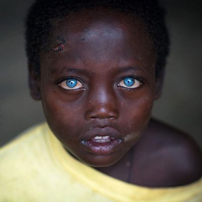 इस बच्चे की आँखें किसी वरदान से नहीं बल्कि बीमारी से हो गयी हैं नीली