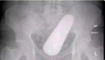 The young man was having pain in his stomach... After operation, the doctors were also stunned.