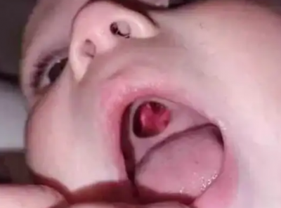 बच्चे के मुंह में छेद देखकर माँ पहुंची अस्पताल, हुआ चौकाने वाला खुलासा