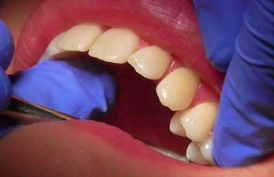 डेंटिस्ट की फीस चुकाने के लिए नहीं थे पैसे, तो महिला ने खुद उखाड़ डाले अपने 11 दांत