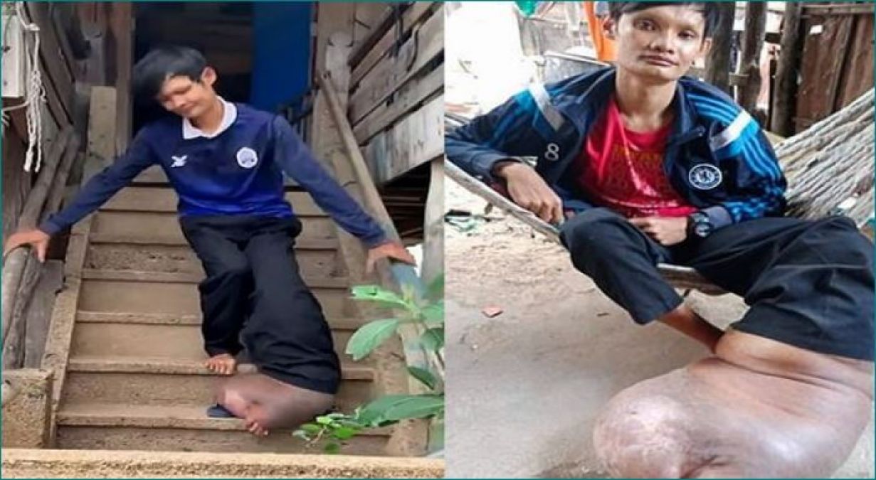 Mosquito bite ruin youth's life, man turns into elephant