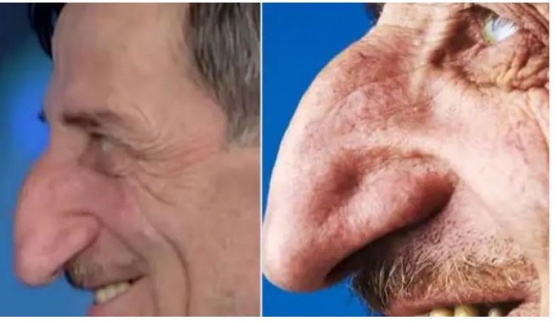 Unusual: This man's nose is growing rapidly!