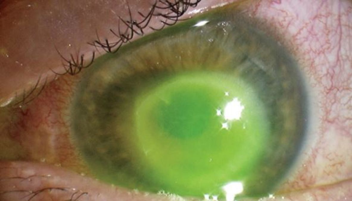 Woman lost her eyesight after bathing, suggested everyone be careful while using lenses