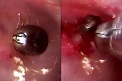 Video : कान से निकला ऐसा कीड़ा, जो खा रहा कान के अंदर का मांस