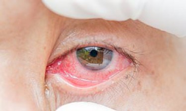 Coronavirus can remain in eyes for 21 days even after infection